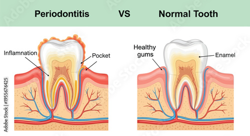 Detailed anatomical comparison showing periodontitis disease progression versus a normal healthy tooth structure
