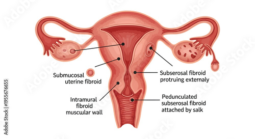 Diagram illustrating the various types and common locations of uterine fibroids in the female reproductive system