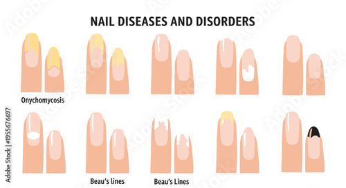 Visual comparison chart illustrating various common finger nail diseases and disorders for medical understanding
