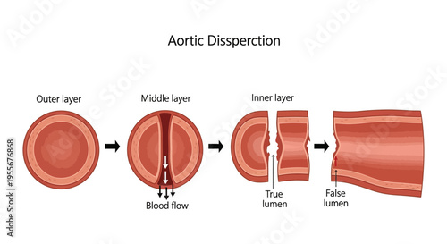 Detailed medical illustration depicting the dangerous progression and formation of an aortic dissection in the aorta.