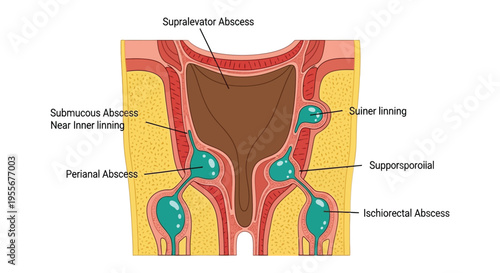 Detailed medical illustration depicting various classifications of anorectal and perianal abscesses in human anatomy.