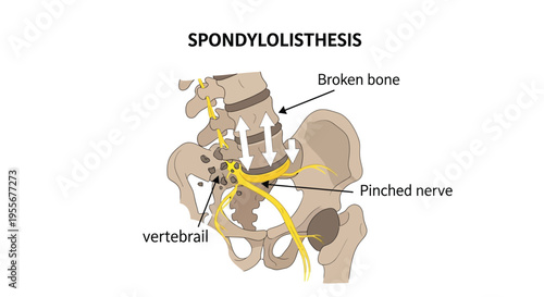 Medical diagram illustrating spondylolisthesis showing a broken bone and resulting pinched nerve roots clearly