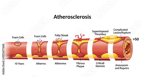 Medical illustration depicts the progressive stages of atherosclerosis development within a human artery over time.