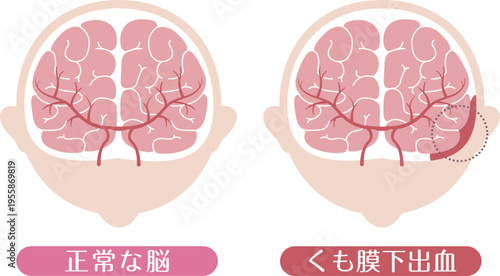 Subarachnoid hemorrhage comparison with normal brain medical illustration