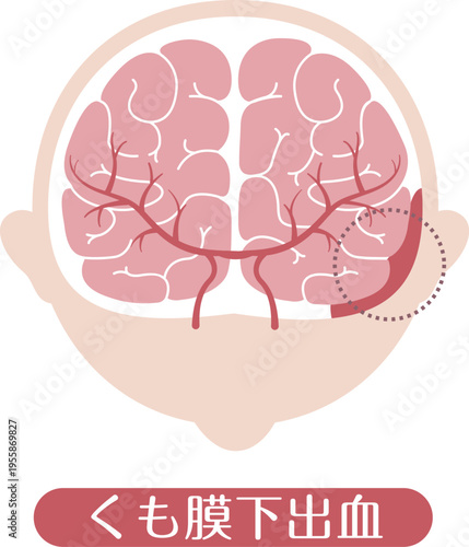 Subarachnoid hemorrhage medical illustration brain bleeding diagram