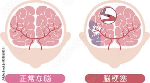Ischemic stroke brain infarction comparison with normal brain medical illustration