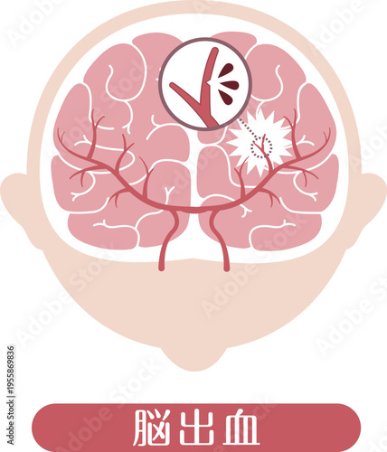 Cerebral hemorrhage medical illustration brain bleeding diagram