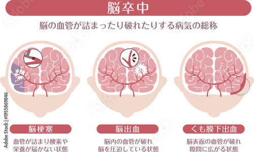 Stroke types medical infographic brain infarction cerebral hemorrhage subarachnoid hemorrhage explanation