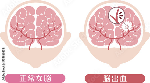 Cerebral hemorrhage comparison with normal brain medical illustration