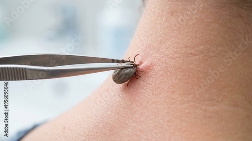 Close-up of the process of removing a tick from human skin with medical tweezers