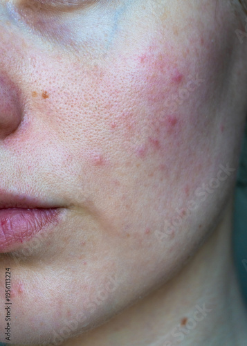 Obraz na plátně Vertical close up of young woman face with acne, redness and uneven skin texture