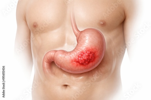 Gastric cancer medical illustration showing stomach wall with localized malignant tumor in oncology and gastroenterology concept for diagnosis pathology education and care