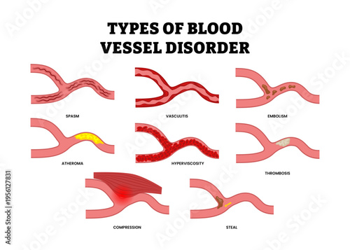 Different types of blood vessel disorder  or vein disorder types set collection. Labeled spasm, vasculitis, embolism, atheroma, hyperviscosity, thrombosis, compression, steal. Circulatory system.
