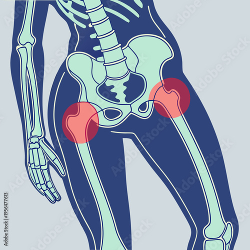 A medical illustration of a human skeleton highlighting hip pain