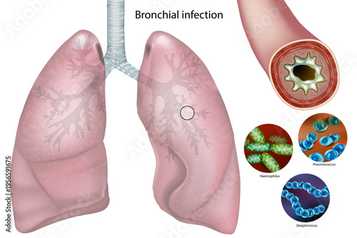 Detailed medical illustration of bacterial bronchitis showing human lungs and cross section of inflamed bronchus with mucus accumulation. Pathogenic bacteria Haemophilus, Pneumococcus, Streptococcus