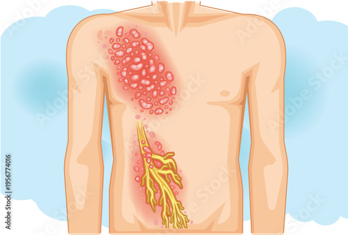 Shingles Rash and Nerve Pain Medical Illustration