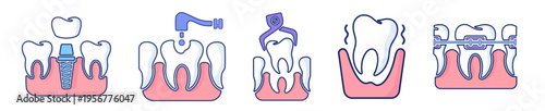 Dental care and stomatology professional procedures dental implant installation, cavity drilling treatment, surgical tooth extraction with forceps, loose tooth symptoms and orthodontic braces for teet