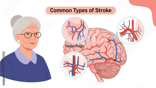 Educational medical graphic about common types of stroke featuring an elderly woman and detailed diagrams of the human brain.