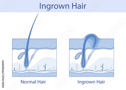 Ingrown hair, hand-drawn anatomical illustration in cartoon style
