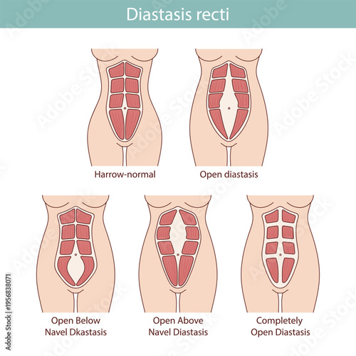 Different types of diastasis. Medical anatomical illustration.