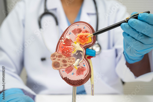 Chronic kidney disease, doctor with model for treatment urinary system, urology, Estimated glomerular filtration rate eGFR.