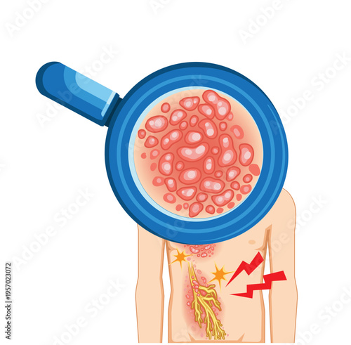 Shingles Rash Close-Up with Nerve Pain Illustration