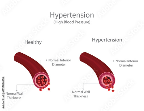 Hypertension vs Healthy Artery Comparison Diagram Showing Blood Vessel Narrowing and High Blood Pressure Medical Illustration.