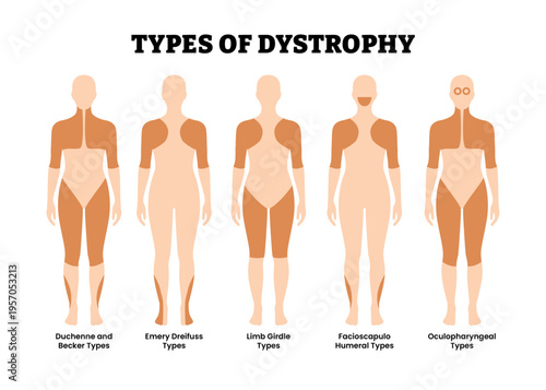 Different types of muscular dystrophy or muscle weakness types classification. Labeled duchenne becker, emery dreifuss, limb girdle, facioscapulohumeral oculopharyngeal. Genetic disease illustration.