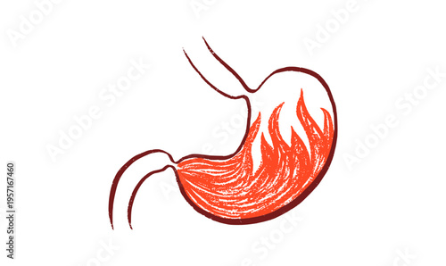 Gastroesophageal reflux pain