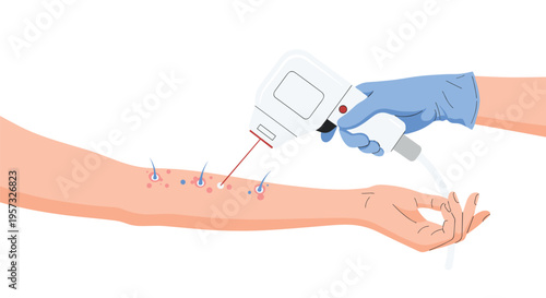 A gloved hand operates a laser device to remove hair and treat red bumps on a person's forearm on a white background.