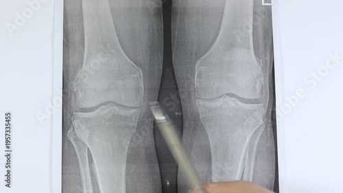 Doctor learn X-ray of knee joint arthritis. Medical scan.