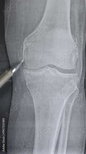 Vertical footage of doctor learn X-ray of knee joint arthritis. Medical scan.