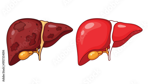 Liver vector illustration of healthy and unhealthy organ