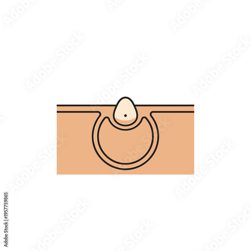 Medical Illustration of Skin Cyst Formation and Treatment Process. Vector Illustrations. EPS Editable