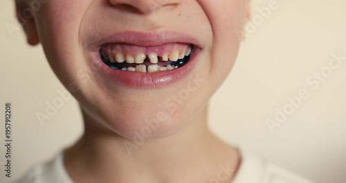 Close-up of a child smile with baby teeth showing plaque and cavities. Children dental hygiene. Dental care.