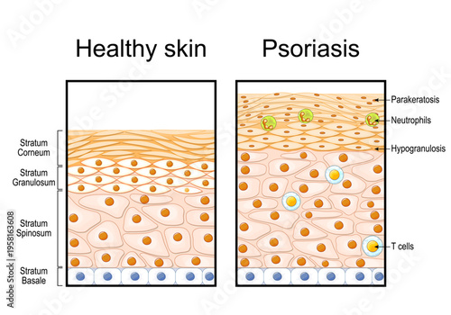 Psoriasis. Comparison of healthy skin epidermis and psoriatic skin structure. 
