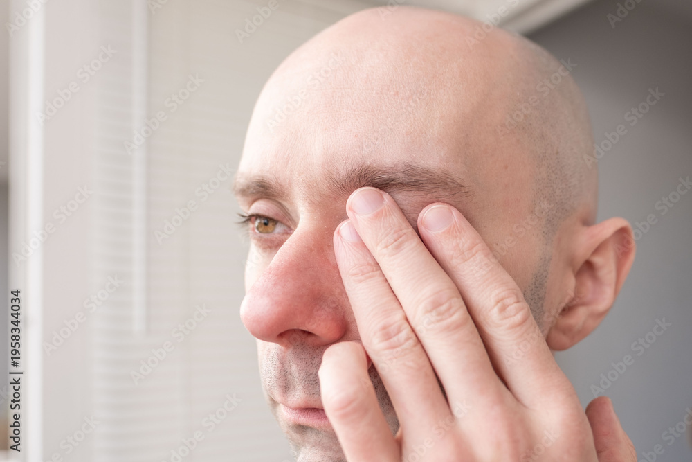 Fototapeta premium man touching area around eye with fingers, looking concerned, vision correction, fatigue, irritation or headache, eye pain, including strain, vision examination, corneal ulcers, acute angle-closure