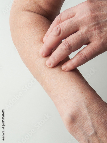 Senior woman touching showing dry skin on arm, dehydration and seasonal disease, aging symptoms.