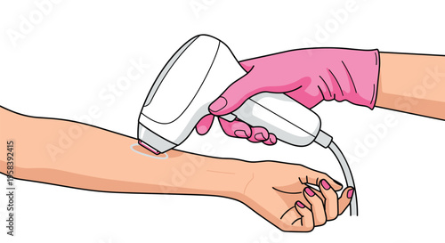 A gloved hand is using an IPL hair removal device on a person's forearm against a white background.