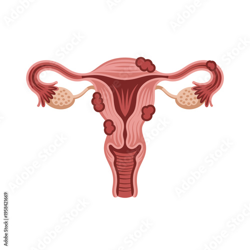 Anatomical illustration of the female reproductive system with uterus and ovaries