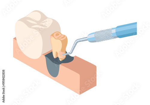 Dental implant placement procedure showing bone graft and surgical instrument