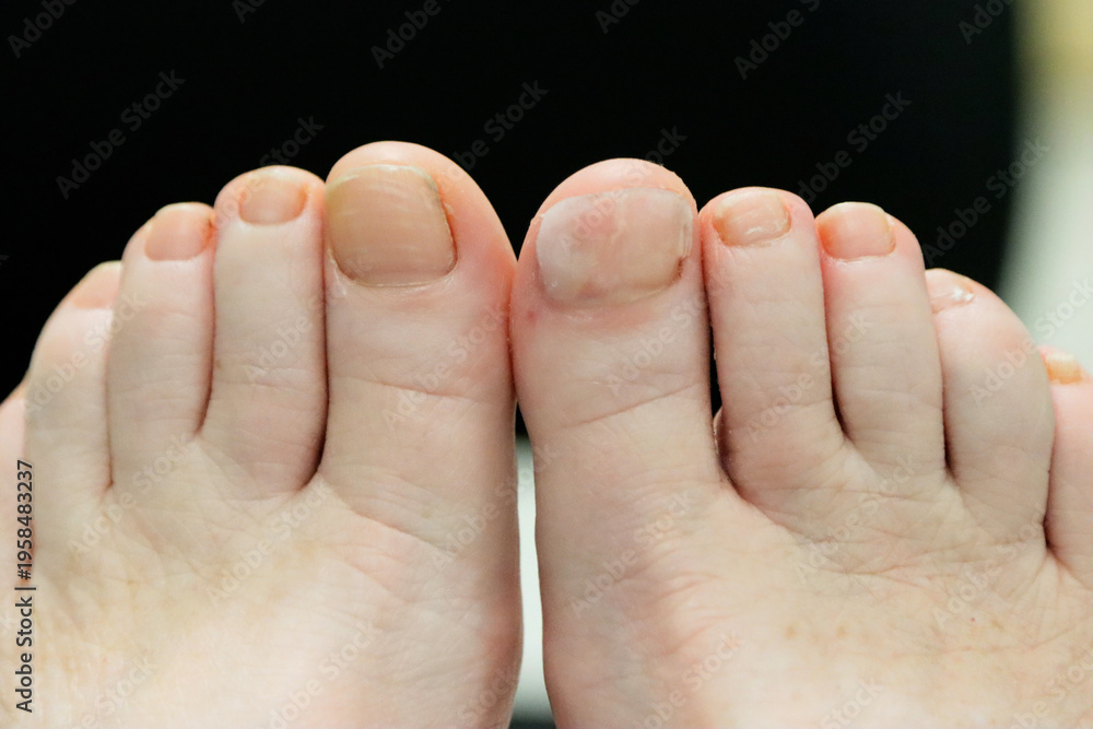 Fototapeta premium Reconstructed toe nail alongside opposite big toe nail