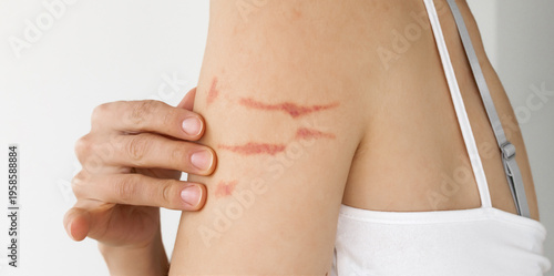 Close-Up of Woman Showing Multiple Red Linear Scratch Marks on Upper Arm and Shoulder — Female Skin with Visible Wounds, Domestic Violence Awareness, Skin Trauma, Victim Support and Healthcare Medical