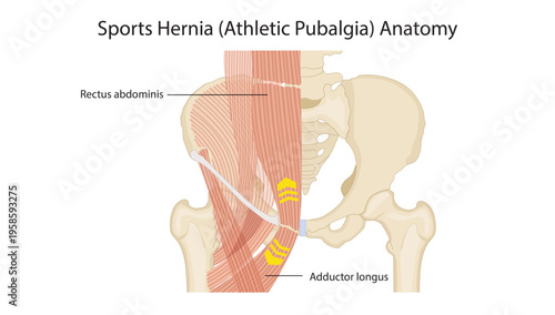 Sports Hernia (Athletic Pubalgia) Anatomy
the relationship between rectus abdominis and adductor longus at the pubic region, highlighting the site of injury in athletic pubalgia.