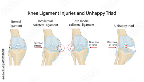 Knee Ligament Injuries and Unhappy Triad
Illustration showing normal knee ligaments, lateral and medial collateral ligament tears, and the classic unhappy triad injury mechanism.