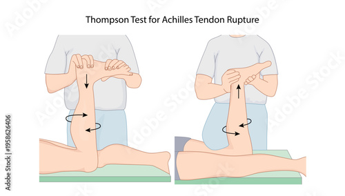 Thompson Test for Achilles Tendon Rupture
Clinical test demonstrating calf squeeze to assess integrity of the Achilles tendon based on plantarflexion response.