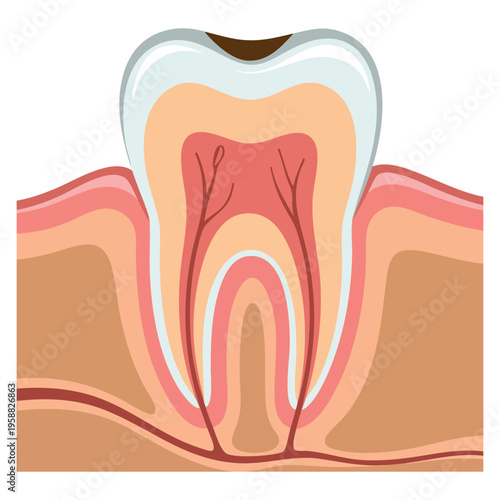 Vector illustration of deep caries tooth problem ideal for dental health awareness dentistry clinic education and oral care design