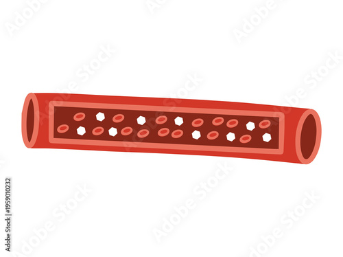 Hyperglycemia High Blood Sugar Level in Blood Vessels
