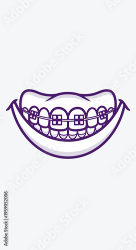 Smiling Mouth Depicting Dental Orthodontic Braces Depicting Healthy Teeth and a Radiant Smile