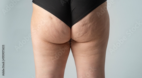 Woman with cellulite. Cellulite on real body closeup. Sagging skin with cellulite closeup. Cellulite on natural female skin.